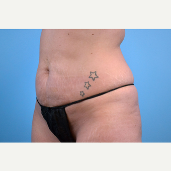 25-34 year old woman treated with Tummy Tuck before 3741580