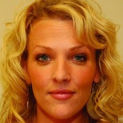 Botox after 1605466