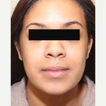 Alarplasty and Weir Excision for a Wide Nose before 3446875
