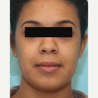 Alarplasty and Weir Excision for a Wide Nose after 3446875