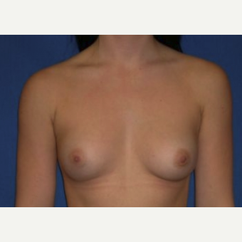 18-24 year old woman treated with Breast Augmentation before 3220047