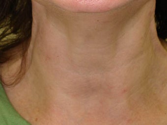 Botox after 989189