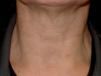 Botox before 989189