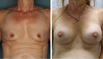 45-54 year old woman treated with Breast Augmentation before 3052709