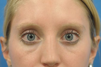 Lower Blepharoplasty at young age -fat pad removal only (eye bags) before 1102682