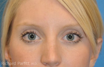 Lower Blepharoplasty at young age -fat pad removal only (eye bags) after 1102682