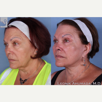 55-64 year old woman treated with Facelift 3094205