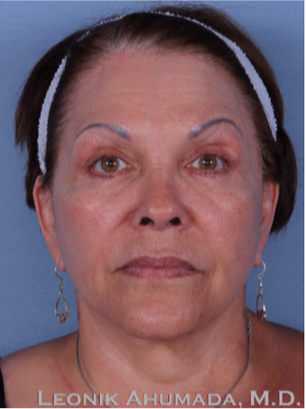 55-64 year old woman treated with Facelift after 3094205