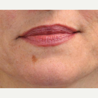 45-54 year old woman treated with Photofacial before 3036825