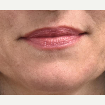 45-54 year old woman treated with Photofacial after 3036825