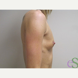 Breast Implants before 3373660