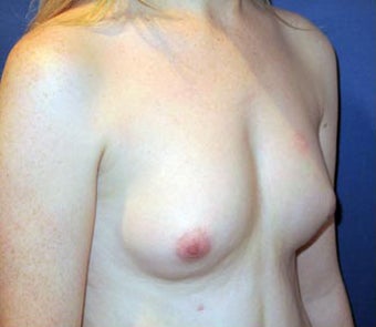 Bilateral Breast Augmentation - Pre- & 9 Months Post-op 3473932
