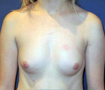 Bilateral Breast Augmentation - Pre- & 9 Months Post-op before 3473932
