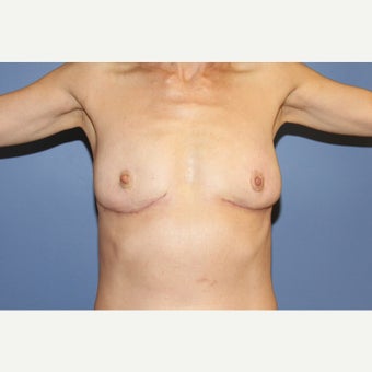 55 year old woman treated with Breast Implant Removal after 1554731