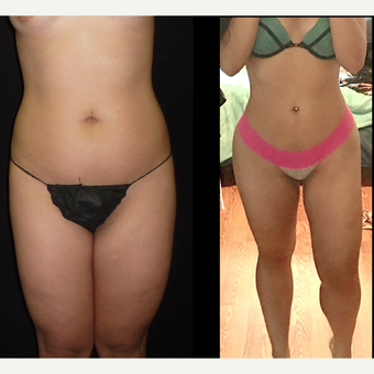 18-24 year old woman treated with Brazilian Butt Lift before 3680305