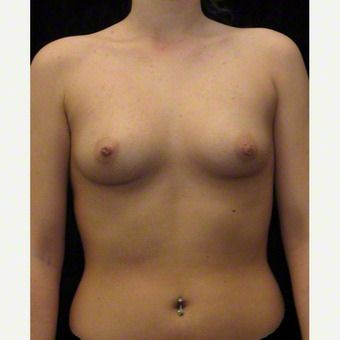 21 year old woman treated with Breast Augmentation before 3103644
