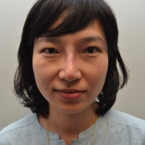 25-34 year old woman treated with Rhinoplasty after 3747698