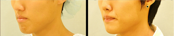 Chin Augmentation after 649423