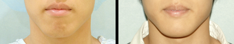 Chin Augmentation before 649423