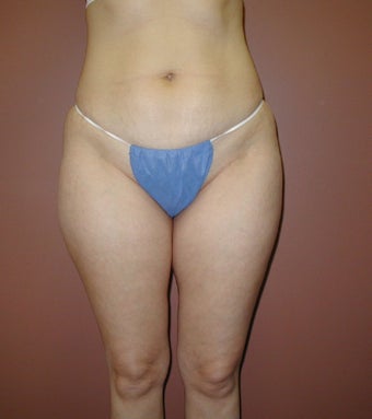 Liposuction of Inner and Outer Thighs and Medial Knee before 1207729