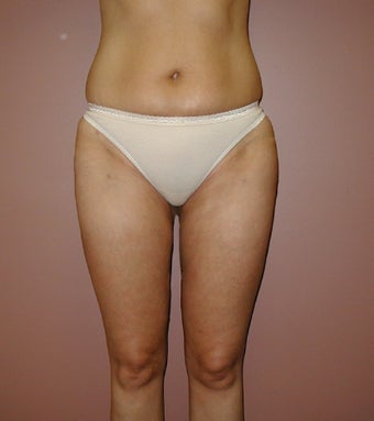 Liposuction of Inner and Outer Thighs and Medial Knee after 1207729