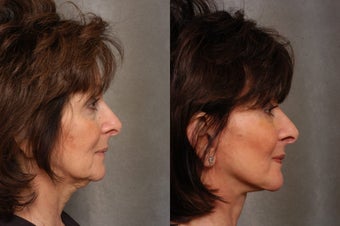 66 year old woman with facial aging 1497849