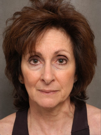 66 year old woman with facial aging before 1497849