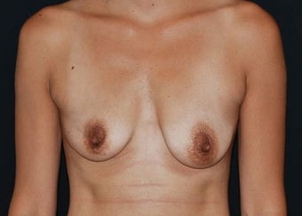 Breast Asymmetry before 949095