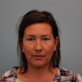 49 year old woman had a Facelift with Dr. Nichter before 3408233