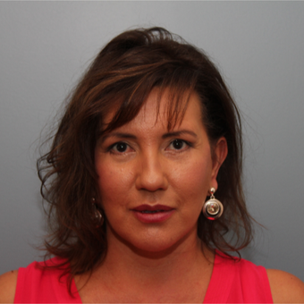 49 year old woman had a Facelift with Dr. Nichter after 3408233