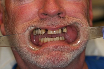 55 year old male treated with All-on-4 Dental Implant Procedure before 1053460