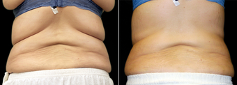Vanquish- Female Treated for Excess Flank and Back Fat before 1486030