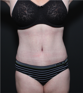 This 35 year old woman underwent full tummy tuck after 1149105