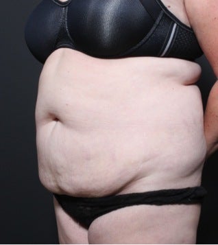 This 35 year old woman underwent full tummy tuck 1149105