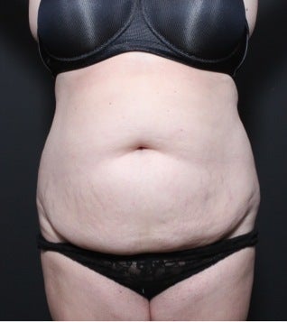 This 35 year old woman underwent full tummy tuck before 1149105
