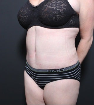 This 35 year old woman underwent full tummy tuck 1149105