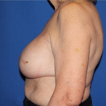 65-74 year old woman treated with Breast Reconstruction after 1984899
