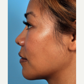 35-44 year old woman treated with Rhinoplasty after 3815656