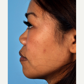35-44 year old woman treated with Rhinoplasty before 3815656