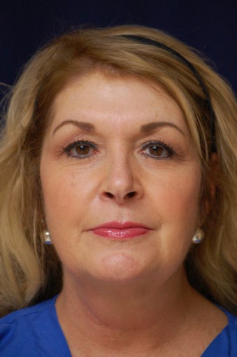 45-54 year old woman treated with Kybella 2375999