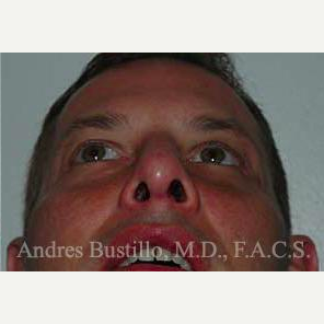 38 year old man treated with Revision Rhinoplasty after 3460803