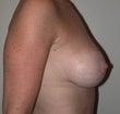 42 year old female patient 911391
