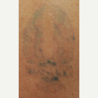 45-54 year old man with PicoSure Laser Tattoo Removal after 3149658
