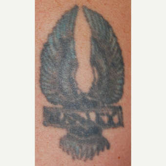 45-54 year old man with PicoSure Laser Tattoo Removal before 3149658