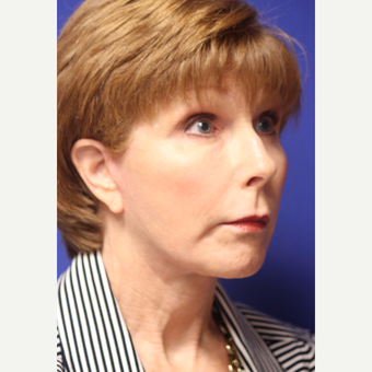 59 year old woman treated with Lower Face and Neck Lift after 3419662
