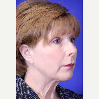 59 year old woman treated with Lower Face and Neck Lift before 3419662