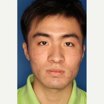 25-34 year old man treated with Acne Treatment after 3709878