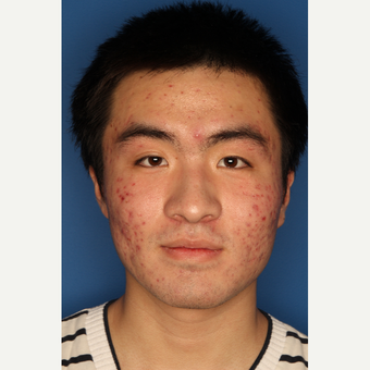 25-34 year old man treated with Acne Treatment before 3709878