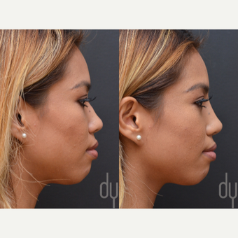 Non Surgical Nose Job before 3622628