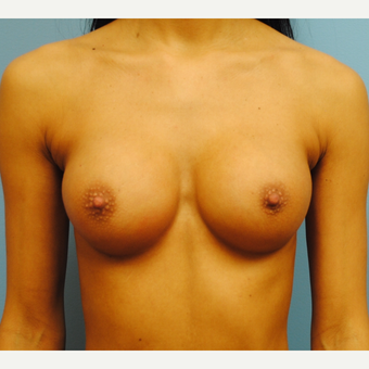 27 year old. Breast augmentation. A to full B cup. 300 cc high profile silicone. after 3304338